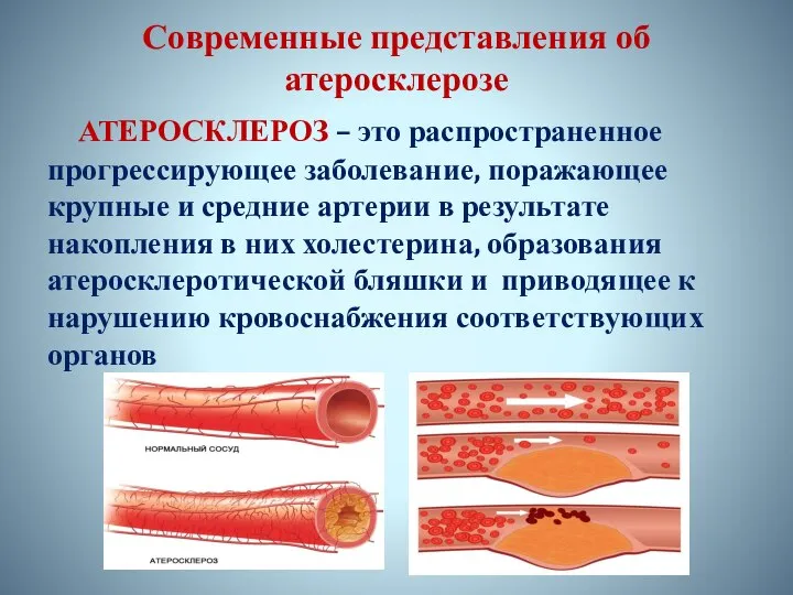 Современные представления об атеросклерозе АТЕРОСКЛЕРОЗ – это распространенное прогрессирующее заболевание, поражающее