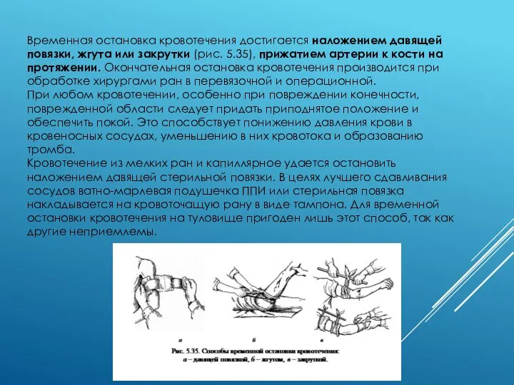 Временная остановка кровотечения достигается наложением давящей повязки, жгута или закрутки (рис.