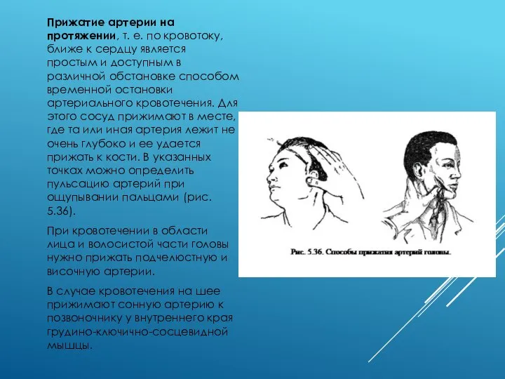 Прижатие артерии на протяжении, т. е. по кровотоку, ближе к сердцу