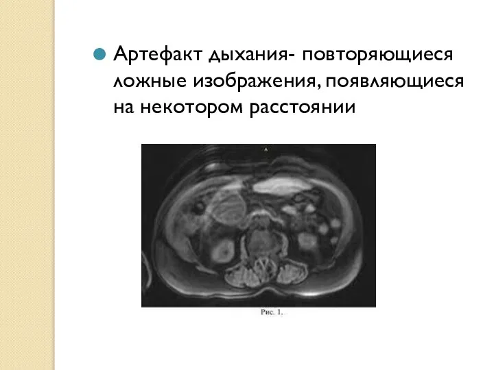 Артефакт дыхания- повторяющиеся ложные изображения, появляющиеся на некотором расстоянии