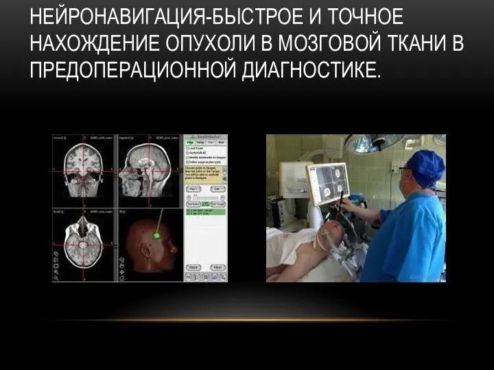 НЕЙРОНАВИГАЦИЯ-БЫСТРОЕ И ТОЧНОЕ НАХОЖДЕНИЕ ОПУХОЛИ В МОЗГОВОЙ ТКАНИ В ПРЕДОПЕРАЦИОННОЙ ДИАГНОСТИКЕ.