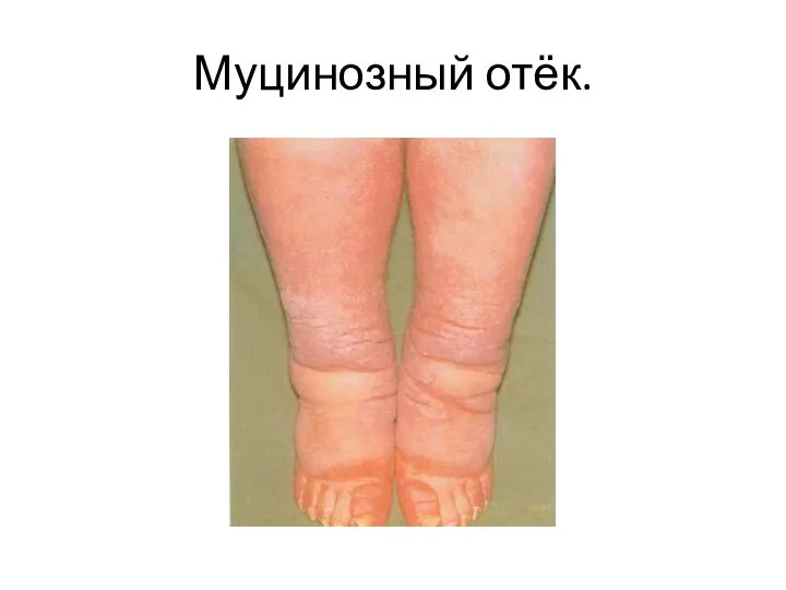 Муцинозный отёк.