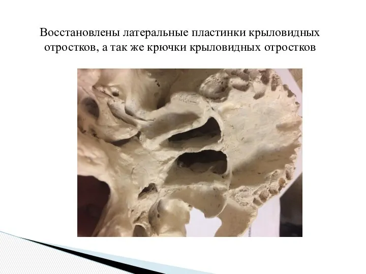 Восстановлены латеральные пластинки крыловидных отростков, а так же крючки крыловидных отростков