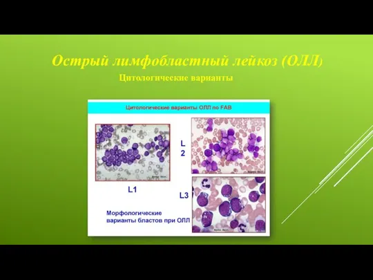 Острый лимфобластный лейкоз (ОЛЛ) Цитологические варианты