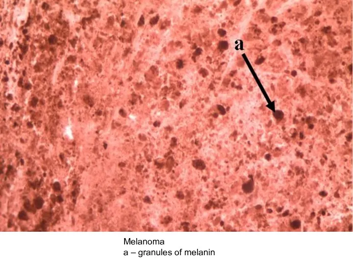 Melanoma а – granules of melanin