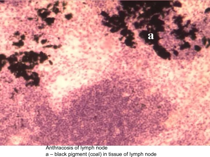 Anthracosis of lymph node а – black pigment (coal) in tissue of lymph node