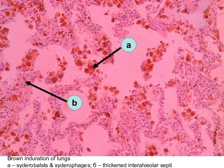 Brown induration of lungs а – syderobalsts & syderophages; б – thickened interalveolar septi a b