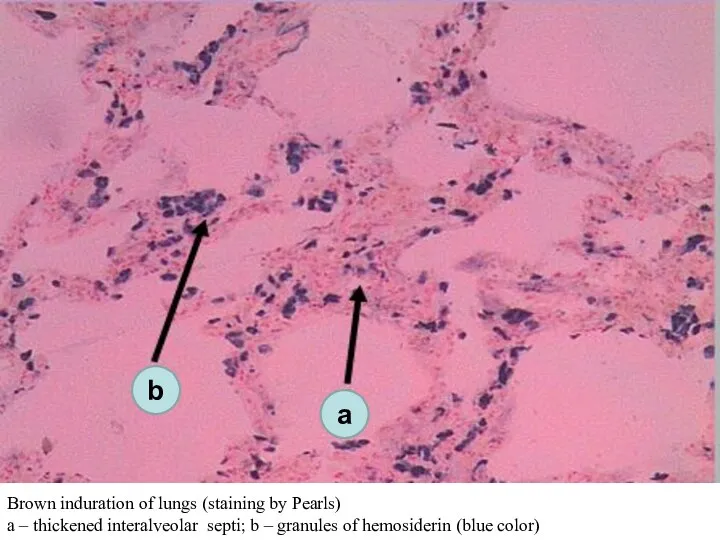 Brown induration of lungs (staining by Pearls) а – thickened interalveolar