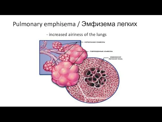Pulmonary emphisema / Эмфизема легких - increased airiness of the lungs