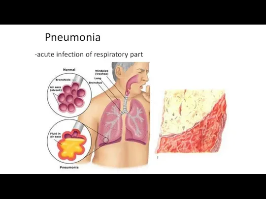 Pneumonia -acute infection of respiratory part