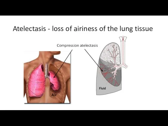 Atelectasis - loss of airiness of the lung tissue Fluid Compression atelectasis Air