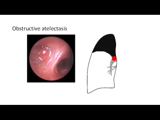 Obstructive atelectasis