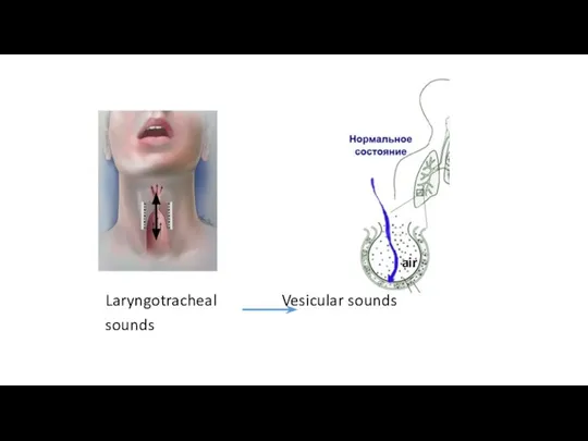 Laryngotracheal Vesicular sounds sounds air