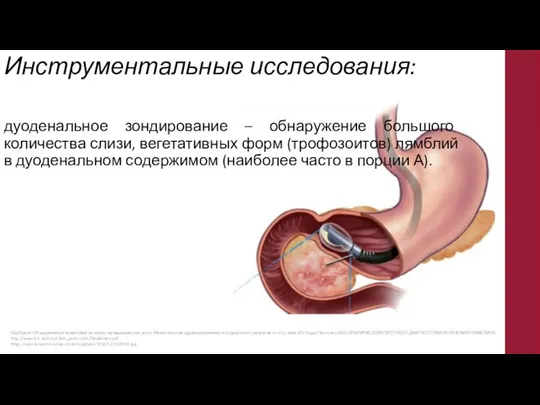 Инструментальные исследования: дуоденальное зондирование – обнаружение большого количества слизи, вегетативных форм