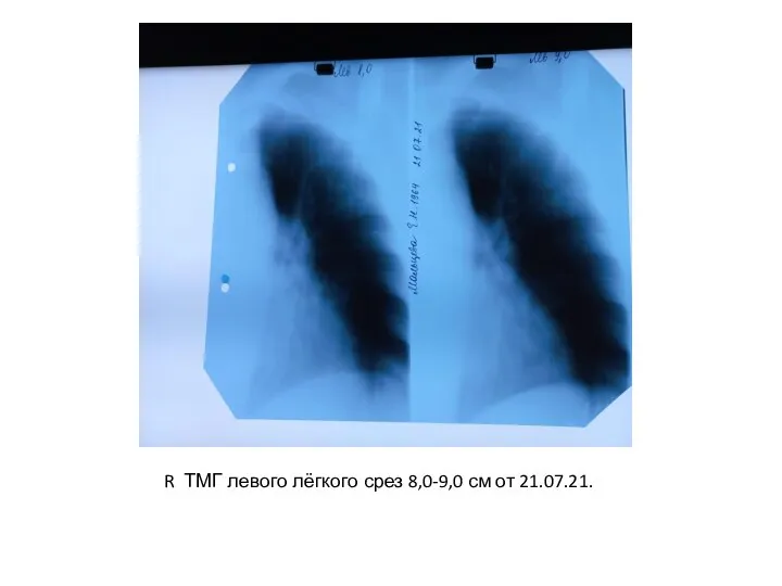 R ТМГ левого лёгкого срез 8,0-9,0 см от 21.07.21.