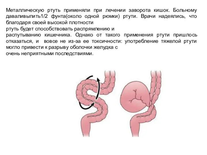 Металлическую ртуть применяли при лечении заворота кишок. Больному даваливыпить1/2 фунта(около одной