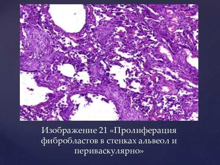 Изображение 21 «Пролиферация фибробластов в стенках альвеол и периваскулярно»