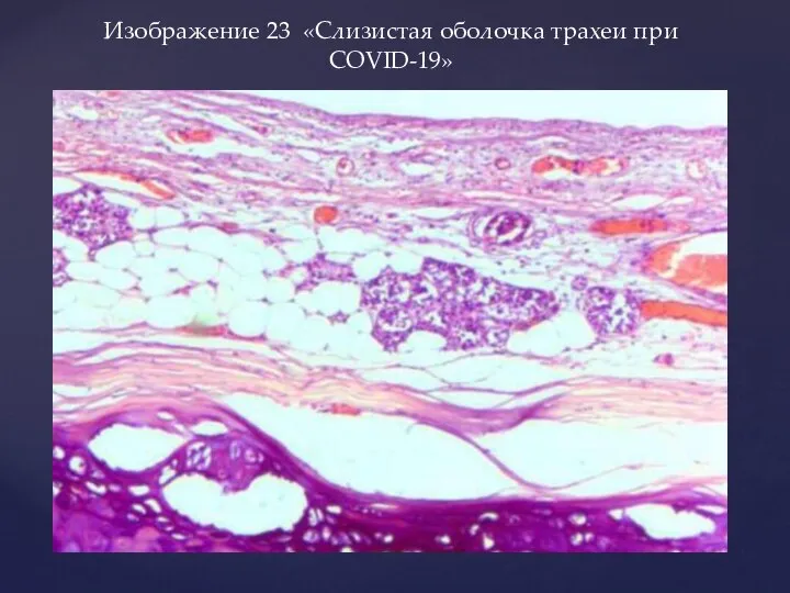 Изображение 23 «Слизистая оболочка трахеи при COVID-19»