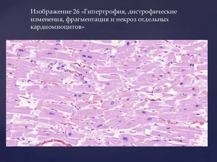 Изображение 26 «Гипертрофия, дистрофические изменения, фрагментация и некроз отдельных кардиомиоцитов»