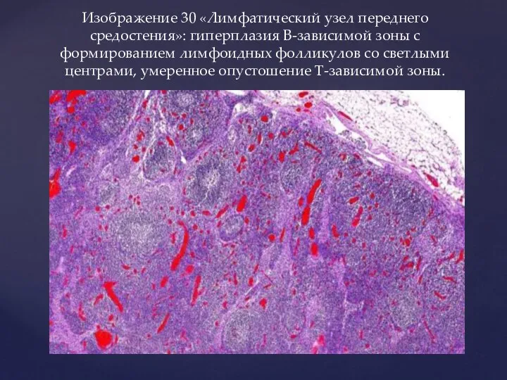 Изображение 30 «Лимфатический узел переднего средостения»: гиперплазия В-зависимой зоны с формированием