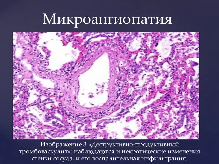 Микроангиопатия Изображение 3 «Деструктивно-продуктивный тромбоваскулит»: наблюдаются и некротические изменения стенки сосуда, и его воспалительная инфильтрация.