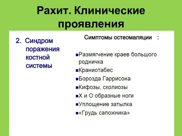 Рахит. Клинические проявления