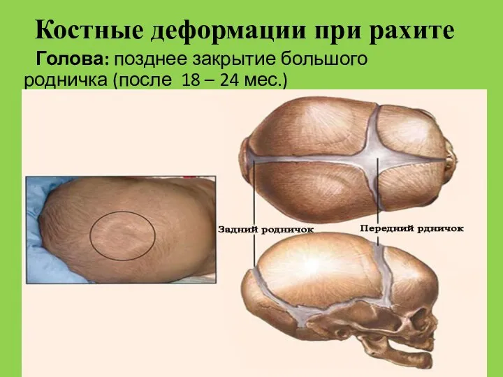 Костные деформации при рахите Голова: позднее закрытие большого родничка (после 18 – 24 мес.)