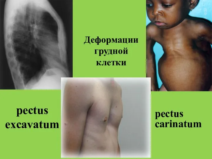 pectus excavatum Деформации грудной клетки pectus carinatum