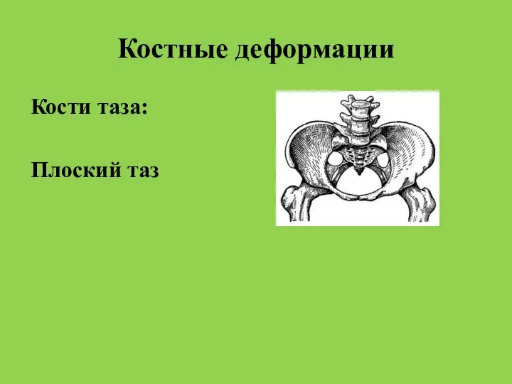 Костные деформации Кости таза: Плоский таз