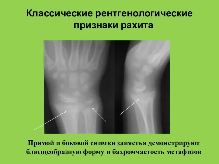 Классические рентгенологические признаки рахита Прямой и боковой снимки запястья демонстрируют блюдцеобразную форму и бахромчастость метафизов