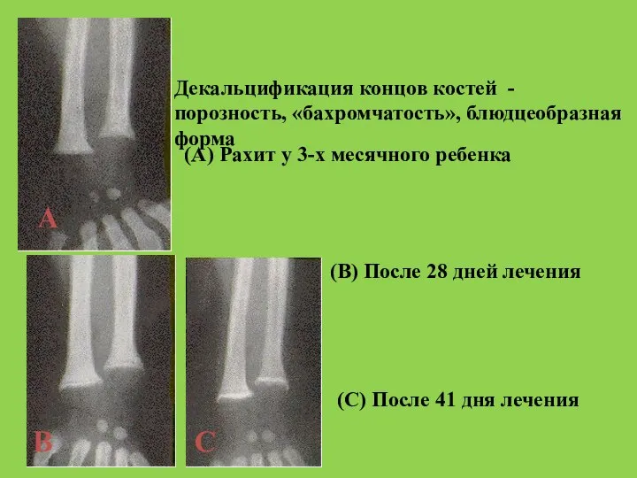 Декальцификация концов костей - порозность, «бахромчатость», блюдцеобразная форма (A) Рахит у