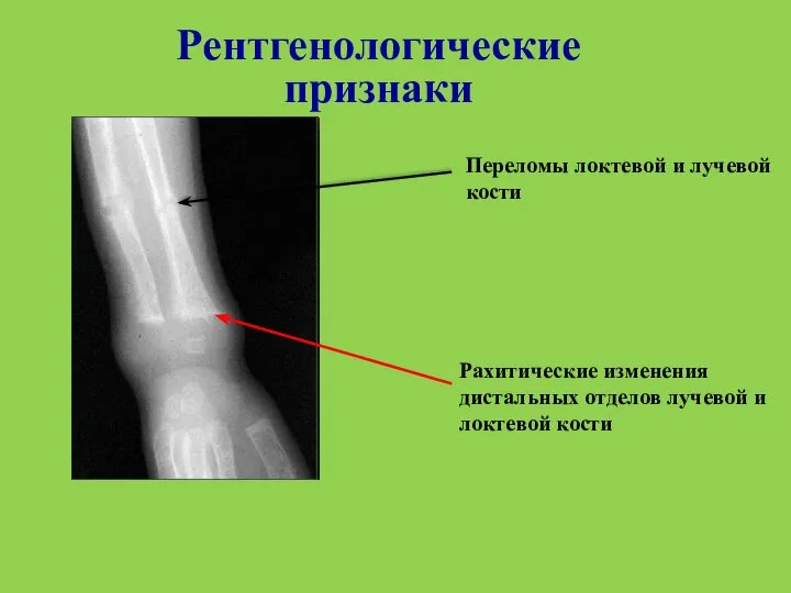 Рентгенологические признаки Переломы локтевой и лучевой кости Рахитические изменения дистальных отделов лучевой и локтевой кости