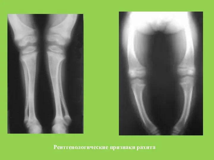 Рентгенологические признаки рахита
