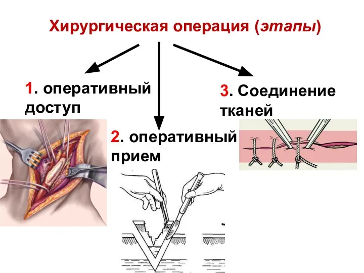 Хирургическая операция (этапы) 2. оперативный прием 1. оперативный доступ 3. Соединение тканей