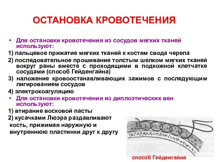 ОСТАНОВКА КРОВОТЕЧЕНИЯ Для остановки кровотечения из сосудов мягких тканей используют: 1)