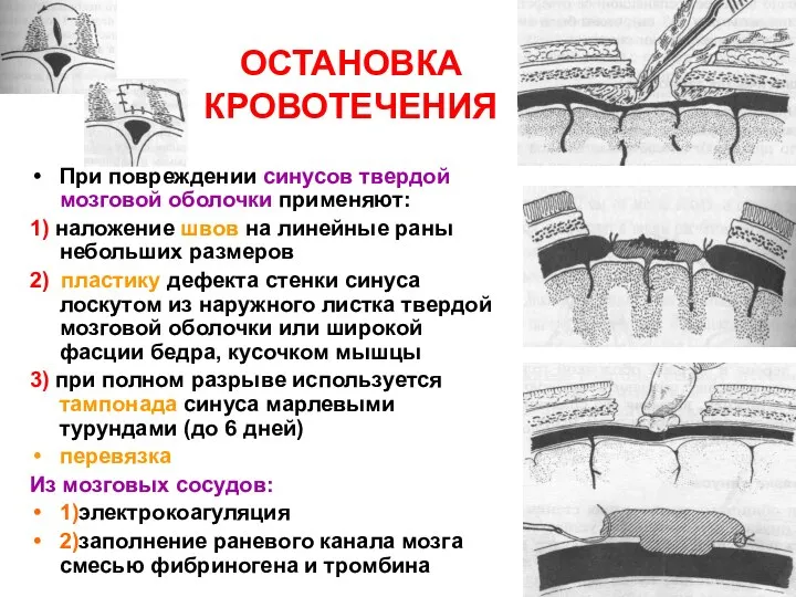 ОСТАНОВКА КРОВОТЕЧЕНИЯ При повреждении синусов твердой мозговой оболочки применяют: 1) наложение