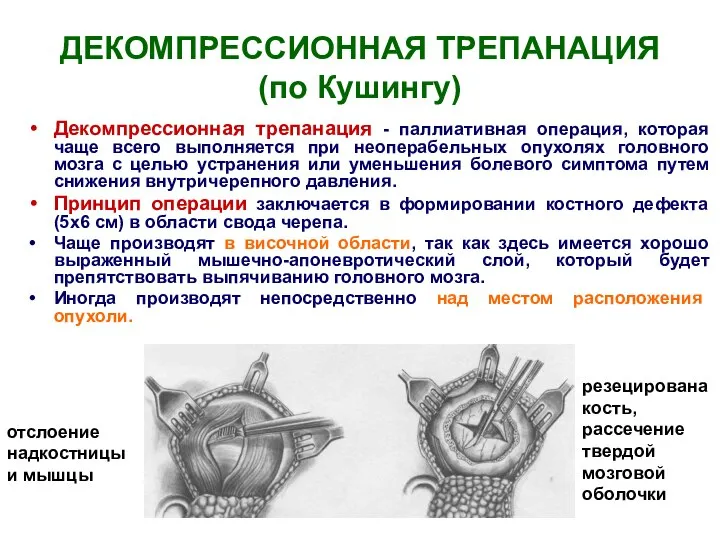 ДЕКОМПРЕССИОННАЯ ТРЕПАНАЦИЯ (по Кушингу) Декомпрессионная трепанация - паллиативная операция, которая чаще