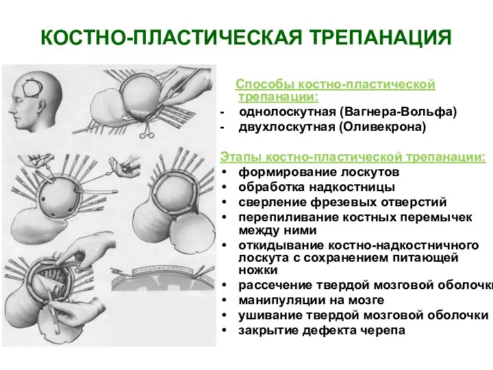 КОСТНО-ПЛАСТИЧЕСКАЯ ТРЕПАНАЦИЯ Способы костно-пластической трепанации: - однолоскутная (Вагнера-Вольфа) - двухлоскутная (Оливекрона)