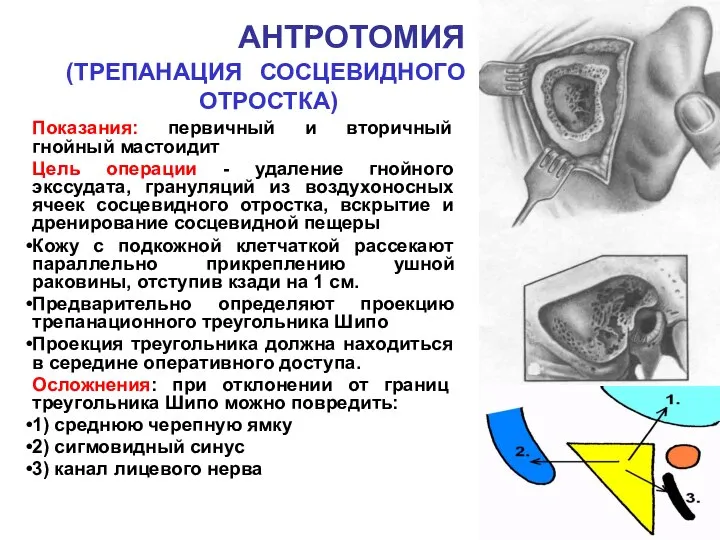 АНТРОТОМИЯ (ТРЕПАНАЦИЯ СОСЦЕВИДНОГО ОТРОСТКА) Показания: первичный и вторичный гнойный мастоидит Цель