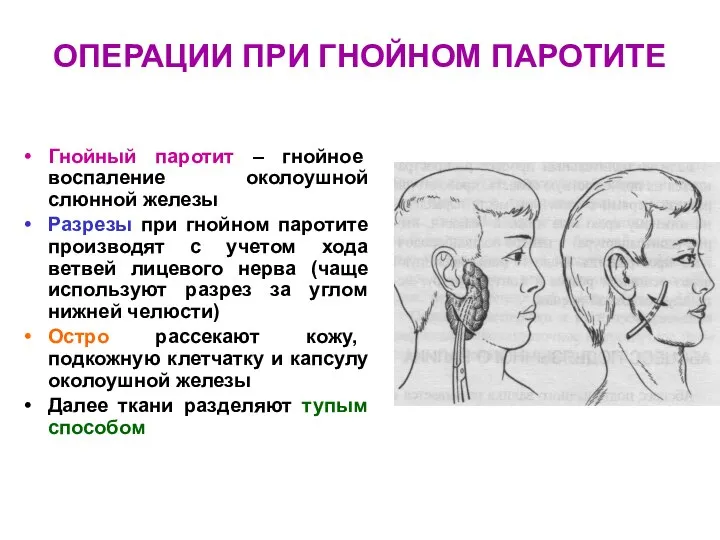 ОПЕРАЦИИ ПРИ ГНОЙНОМ ПАРОТИТЕ Гнойный паротит – гнойное воспаление околоушной слюнной