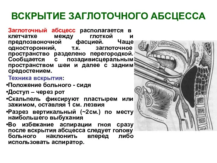 ВСКРЫТИЕ ЗАГЛОТОЧНОГО АБСЦЕССА Заглоточный абсцесс располагается в клетчатке между глоткой и