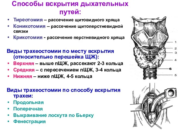 Способы вскрытия дыхательных путей: Тиреотомия – рассечение щитовидного хряща Коникотомия –