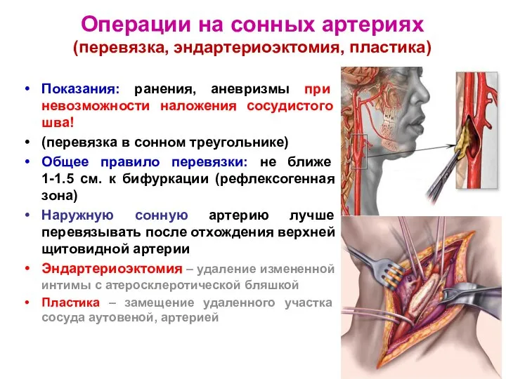 Операции на сонных артериях (перевязка, эндартериоэктомия, пластика) Показания: ранения, аневризмы при