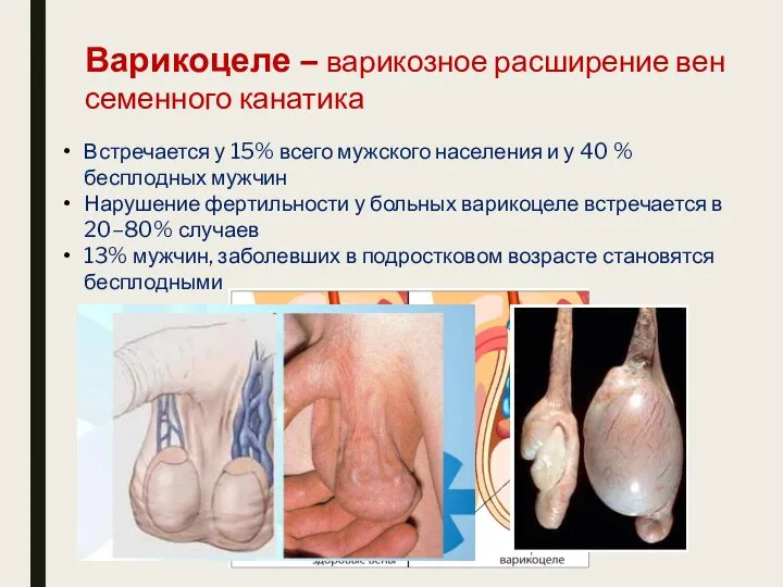 Варикоцеле – варикозное расширение вен семенного канатика Встречается у 15% всего