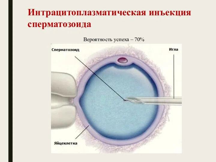 Интрацитоплазматическая инъекция сперматозоида Вероятность успеха – 70%