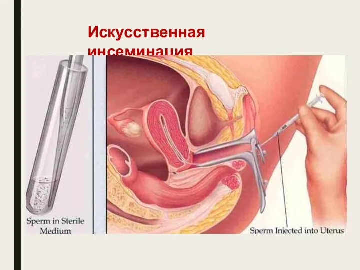 Искусственная инсеминация