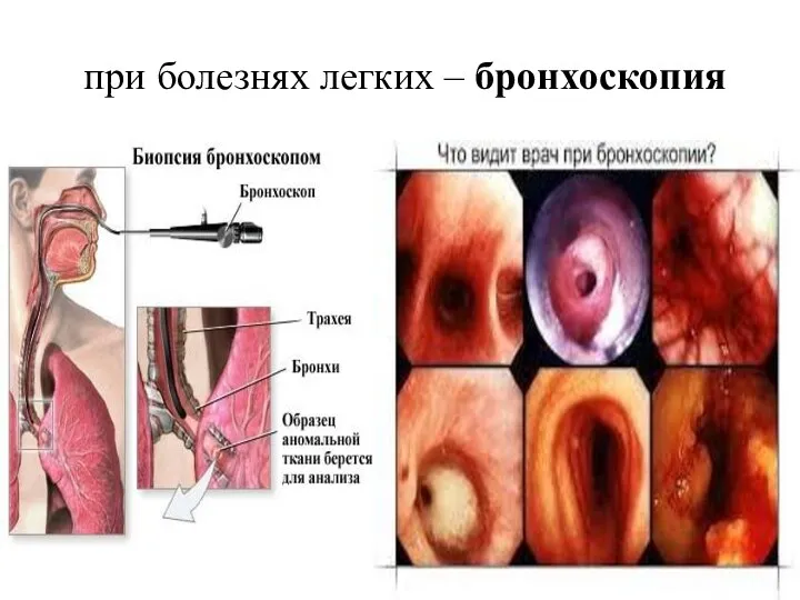 при болезнях легких – бронхоскопия