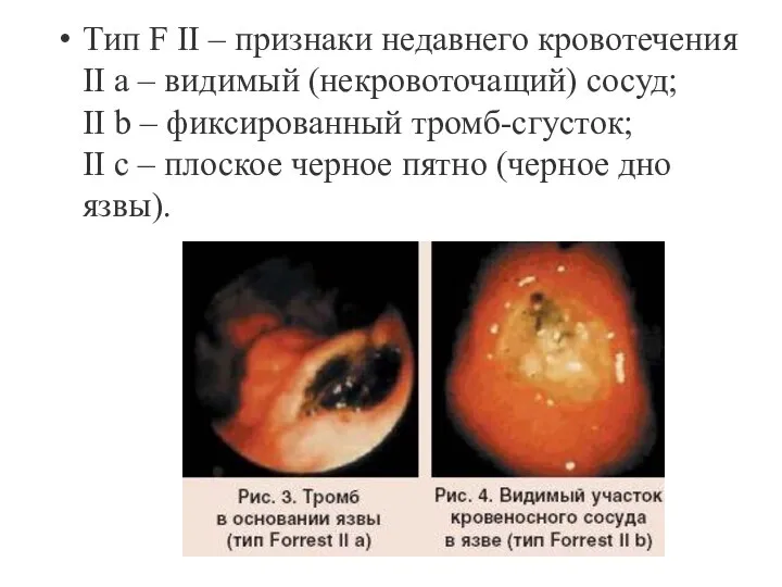 Тип F II – признаки недавнего кровотечения II а – видимый