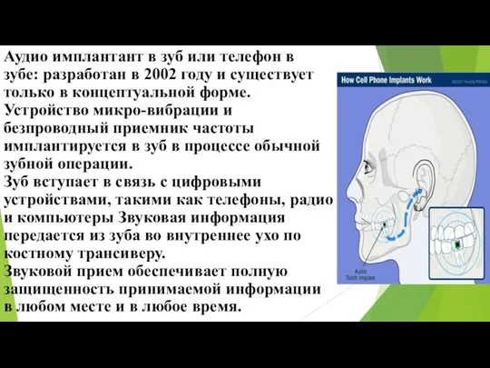 Аудио имплантант в зуб или телефон в зубе: разработан в 2002