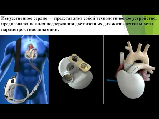 Искусственное сердце — представляет собой технологическое устройство, предназначенное для поддержания достаточных для жизнедеятельности параметров гемодинамики.